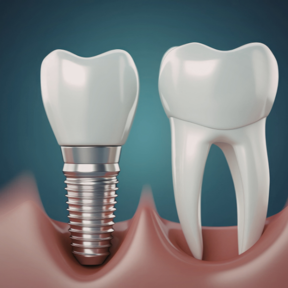 Dental Implants