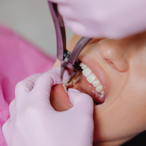 Wisdom Tooth Removal