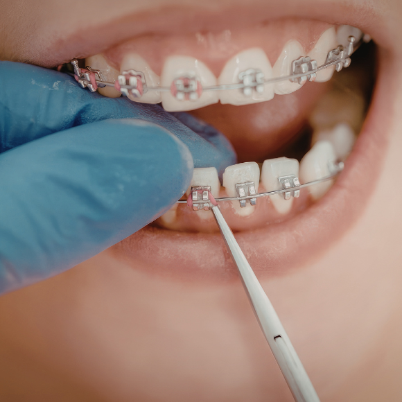 Orthodontic Braces